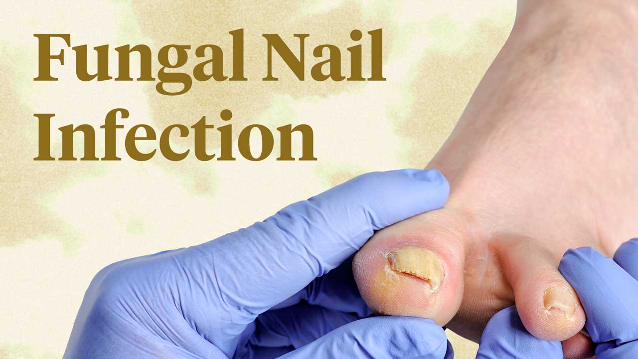Image for Fungal Nail Infections