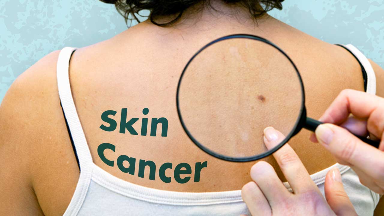 Image for Focus on Skin Cancer: An Overview
