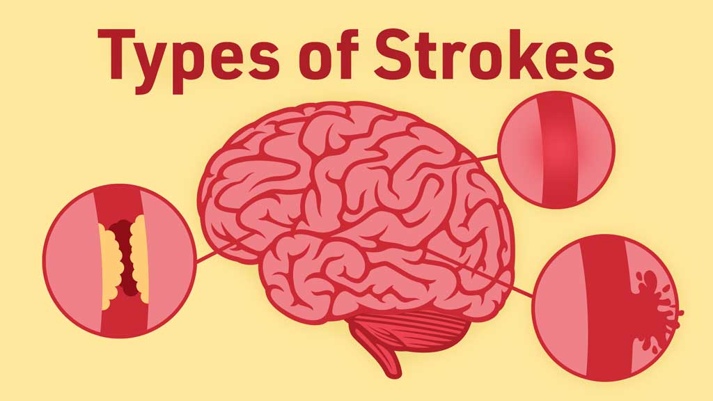 different types of strokes