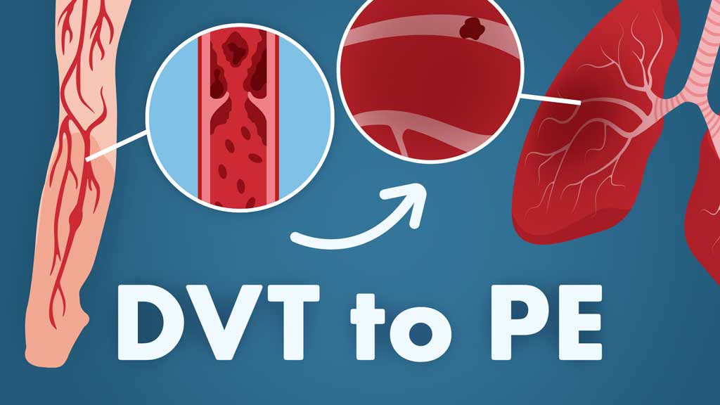 Cover image for: Pulmonary Embolism: DVT to PE