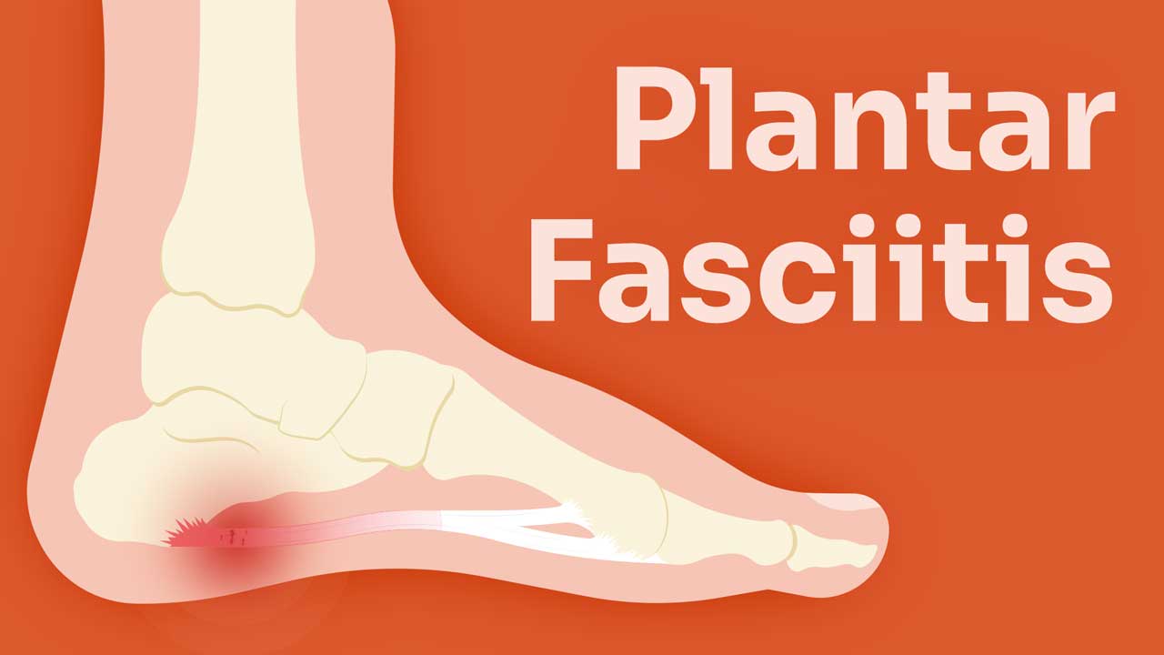 Image for Plantar Fasciitis and Foot Pain in Nursing