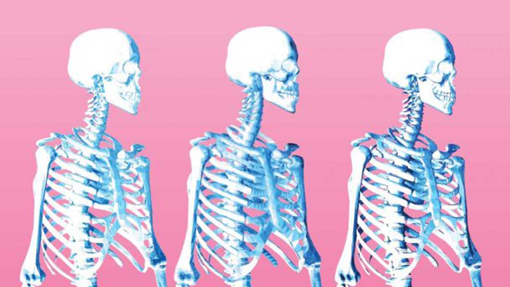 Image for Osteogenesis Imperfecta: Fragile Bones