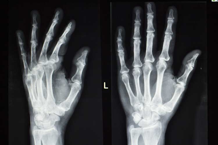 arthritis hands x-ray