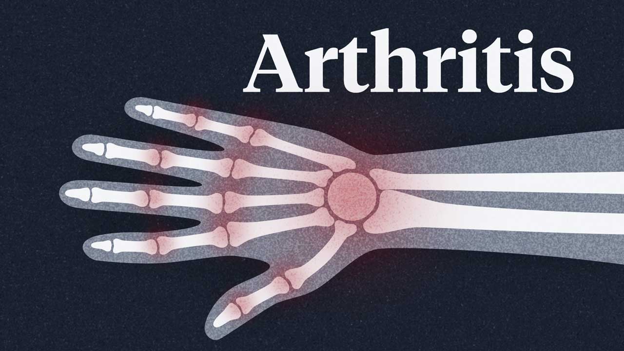Image for A Big Picture Look at Arthritis in Australia