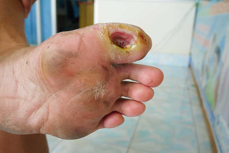 diabetes-related foot disease ulcer