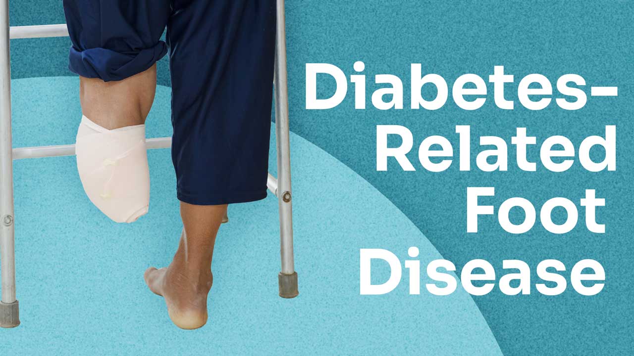 Image for Diabetes-Related Foot Disease Explained