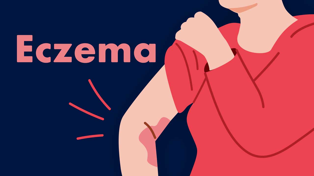 Image for Eczema Symptoms and Management