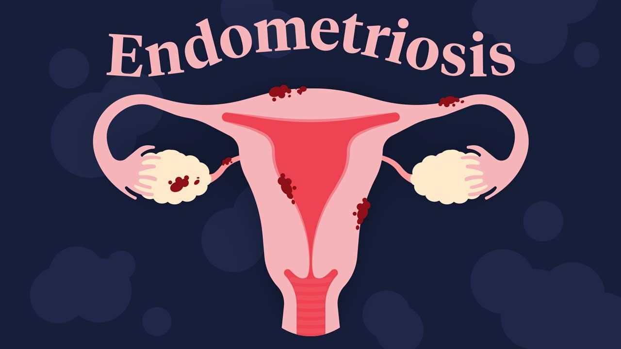 Image for Examining Endometriosis