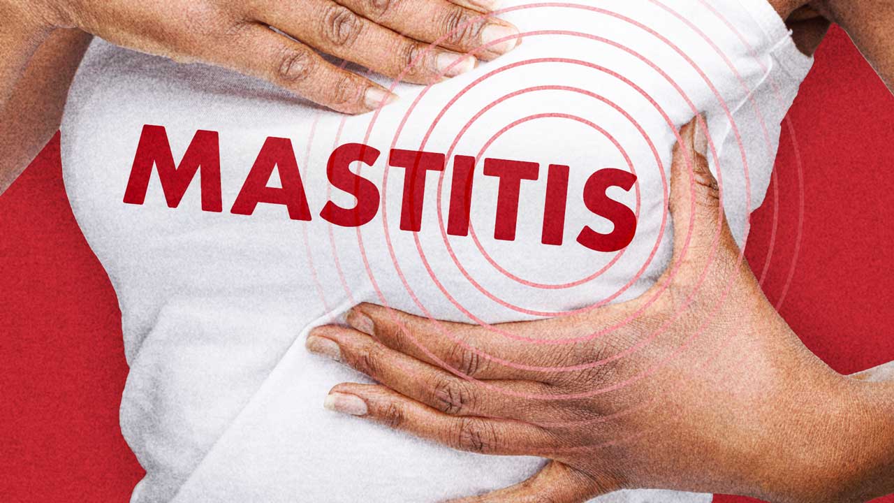 Image for Managing Mastitis