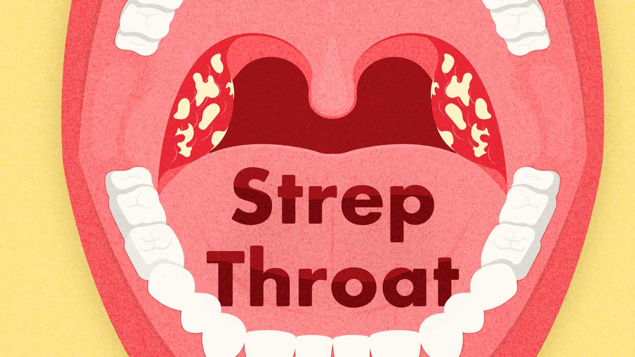 Image for All About Strep Throat