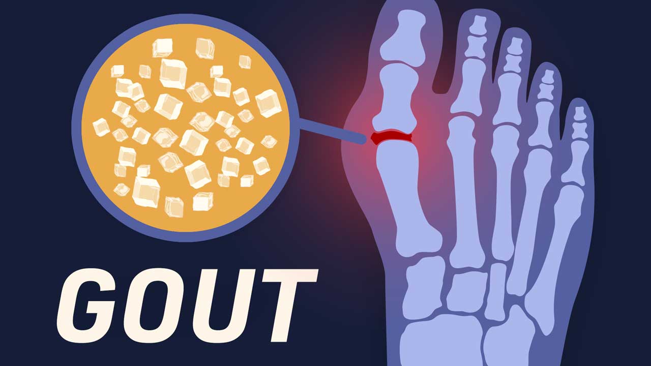 Image for Gaining an Understanding of Gout 