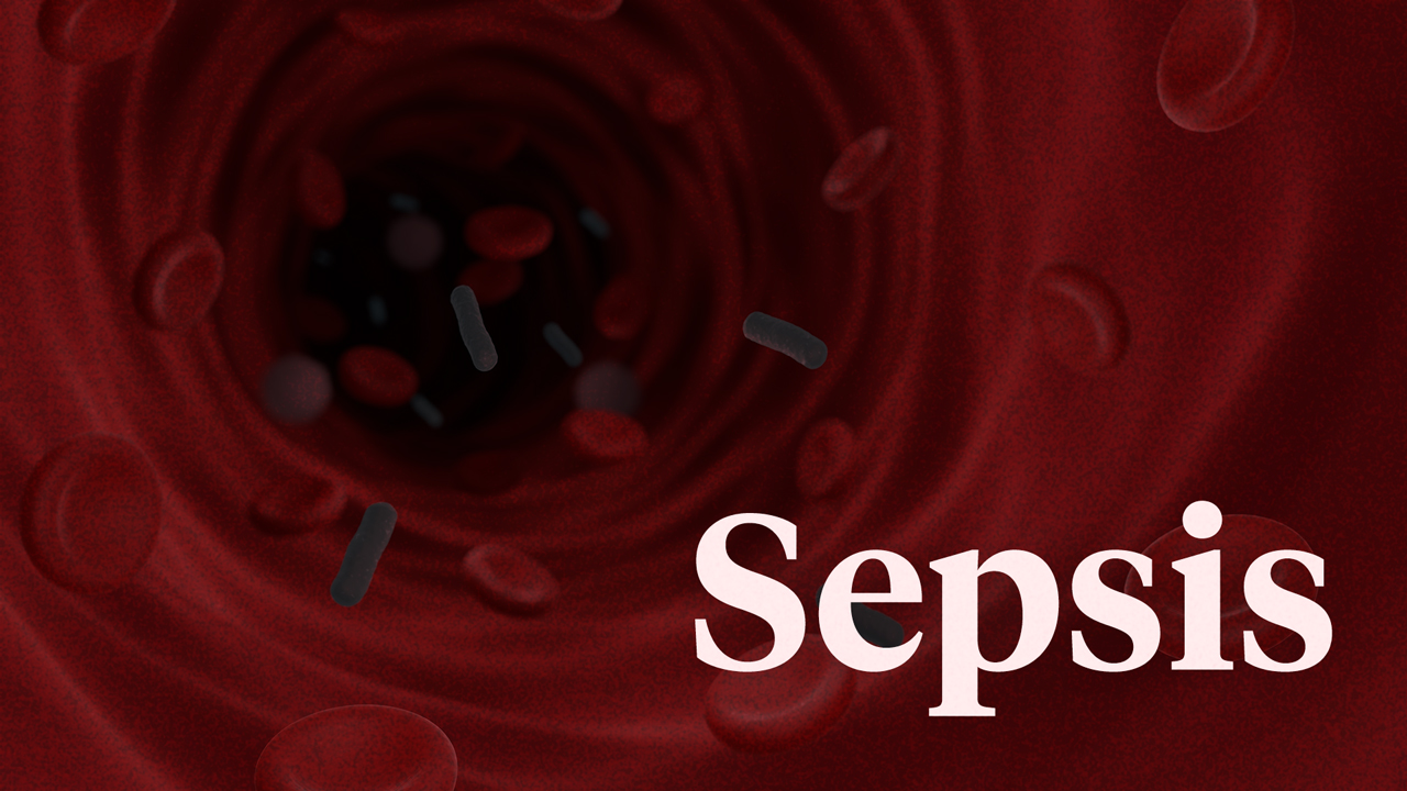Image for Sepsis: Signs and Symptoms