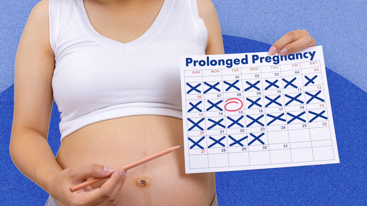 Image for Prolonged Pregnancy 