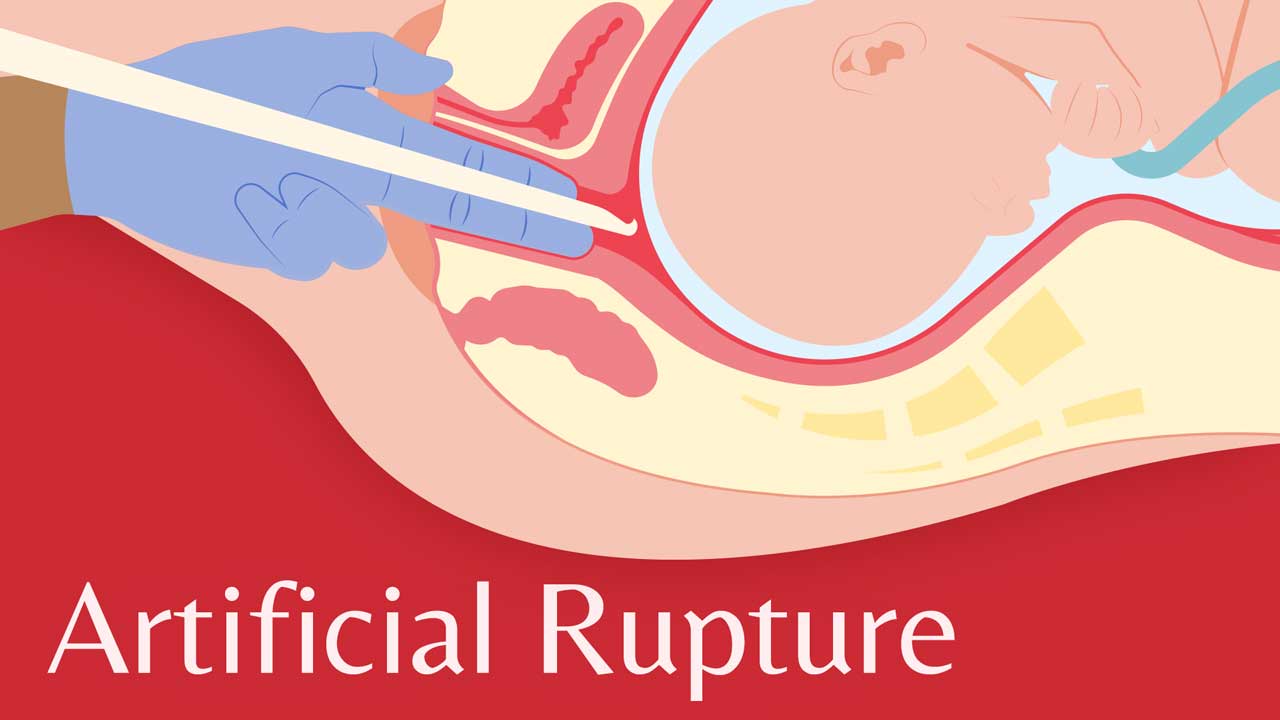 Cover image for: Artificial Rupture of the Membranes in Labour