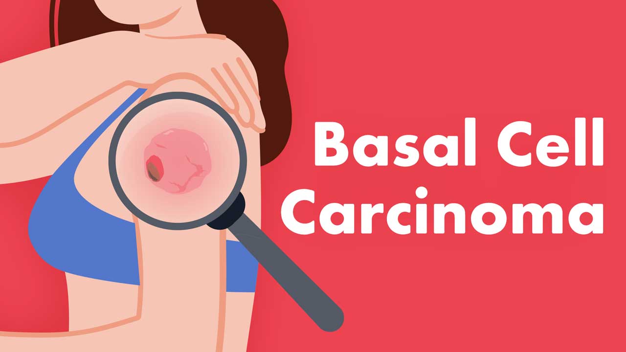 Image for Basal Cell Carcinoma (BCC): Is it on Your Radar?