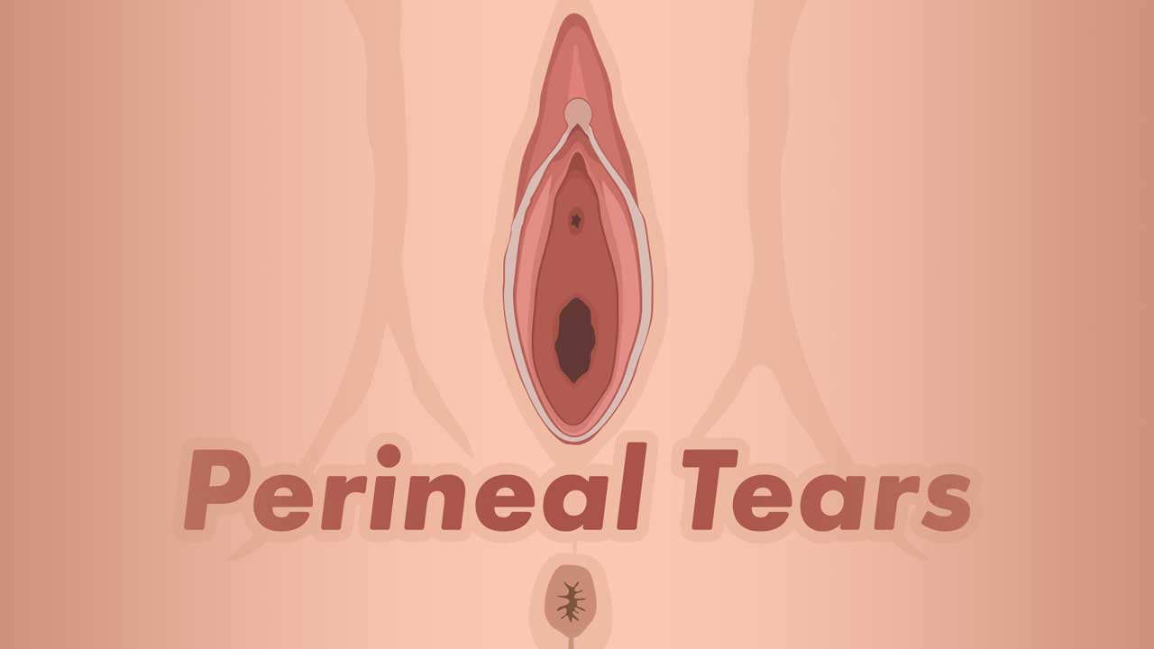 Image for Third and Fourth Degree Perineal Tears Explained
