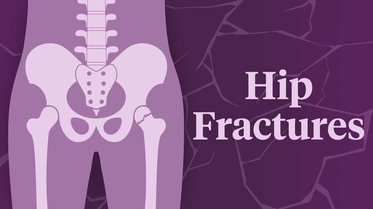 Image for Preventing and Treating Hip Fractures