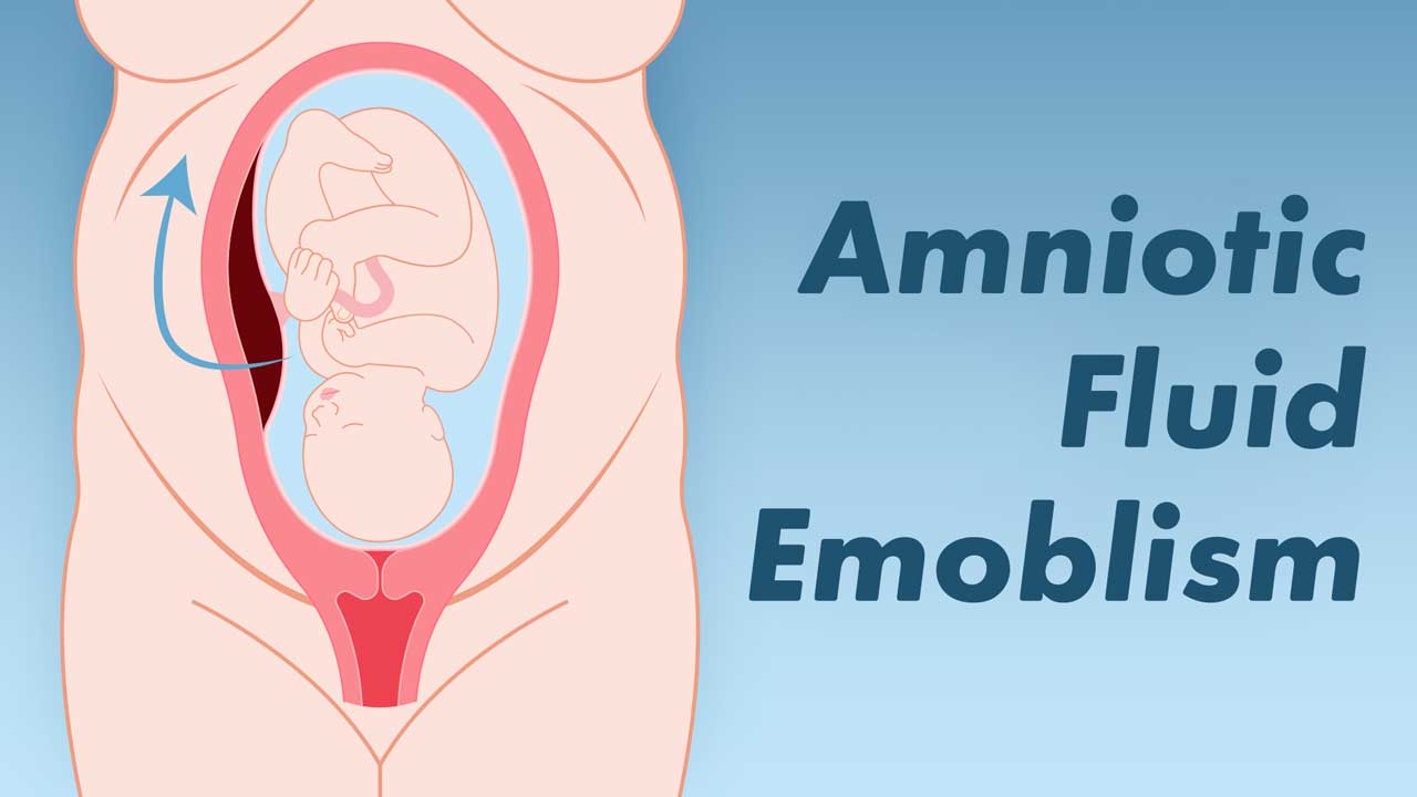 Image for An in-Depth Look at Amniotic Fluid Embolism