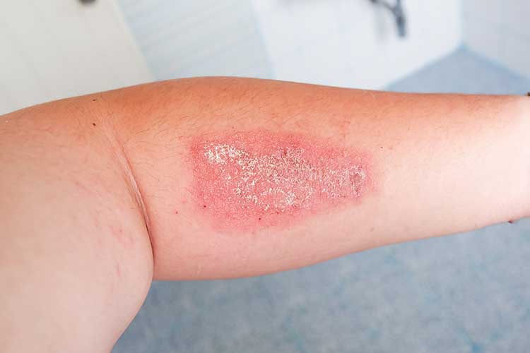 sabsi staph skin infection