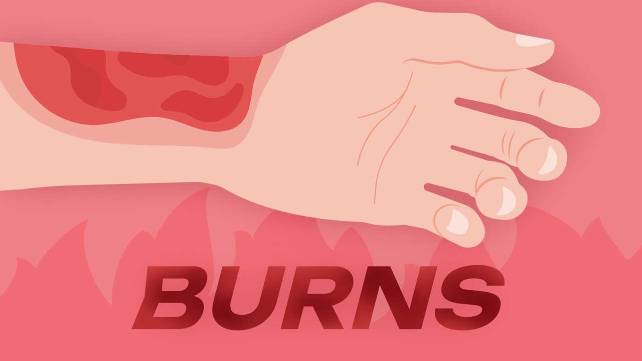 Image for Acute Management of Burn and Scald Injuries in Adults