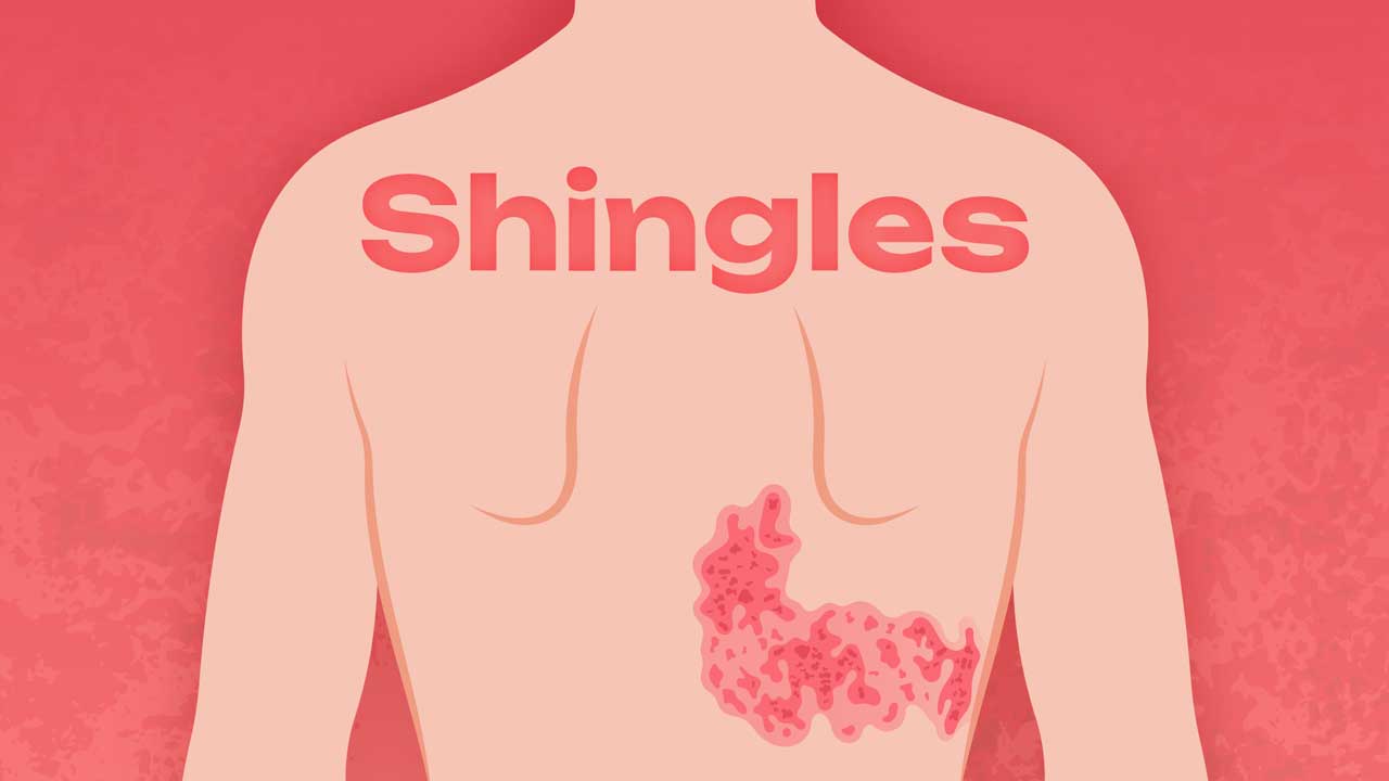 Image for What Causes Shingles (Herpes Zoster)?