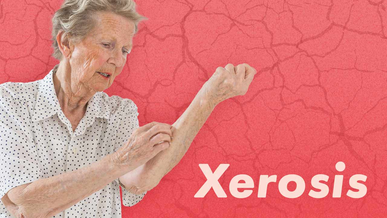 Cover image for: Xerosis (Dry Skin) in Older Adults