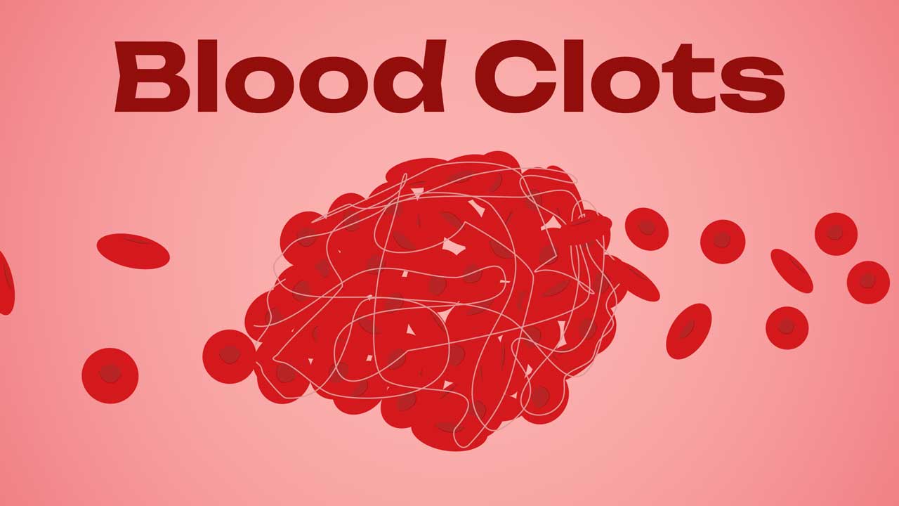 Cover image for: An Introduction to Blood Clots