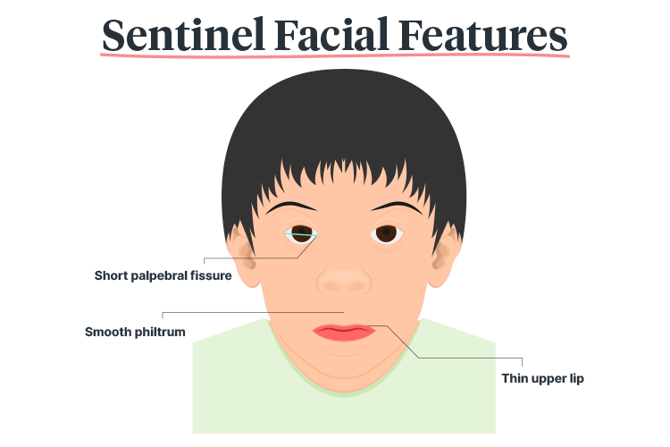 fetal alcohol spectrum disorder sentinel facial features