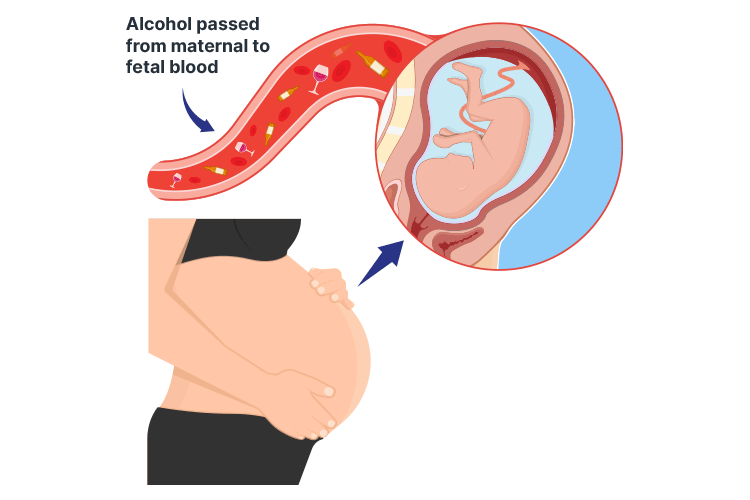 fetal alcohol spectrum disorder alcohol entering fetal bloodstream