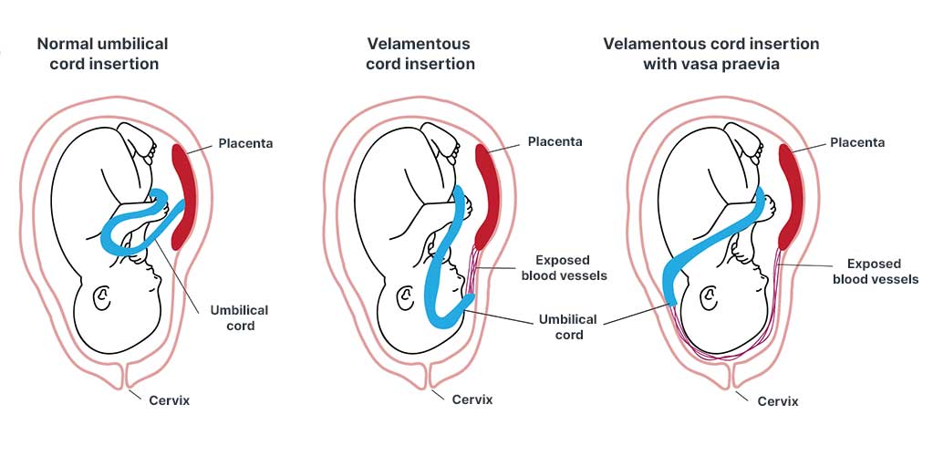 vasa praevia with velamentous cord insertion