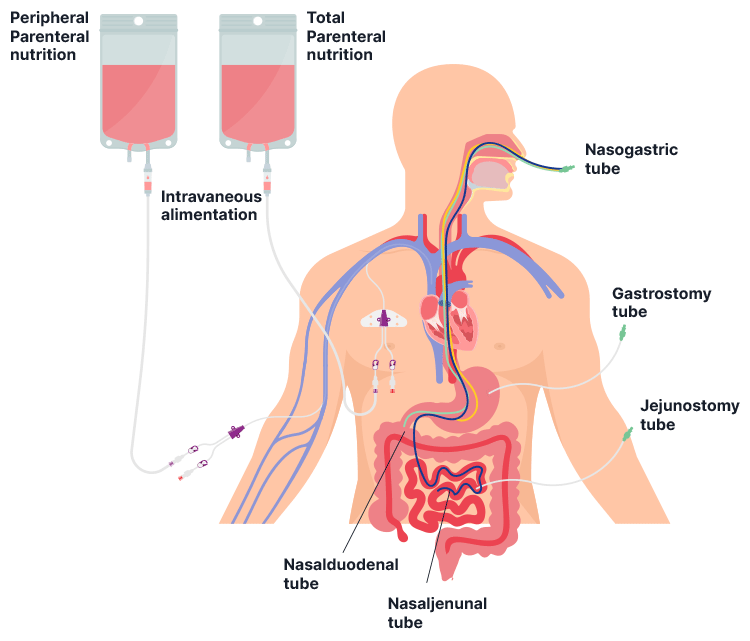 types of enteral feeding diagram