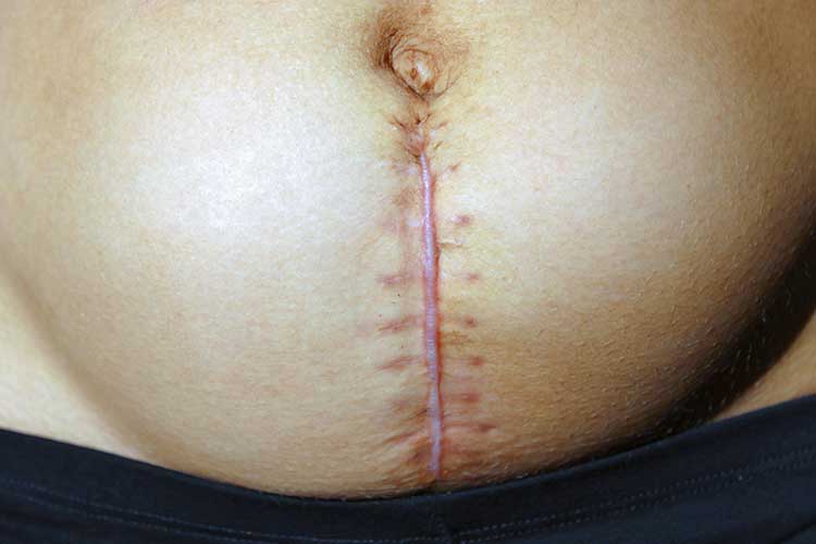 caesarean birth incision
