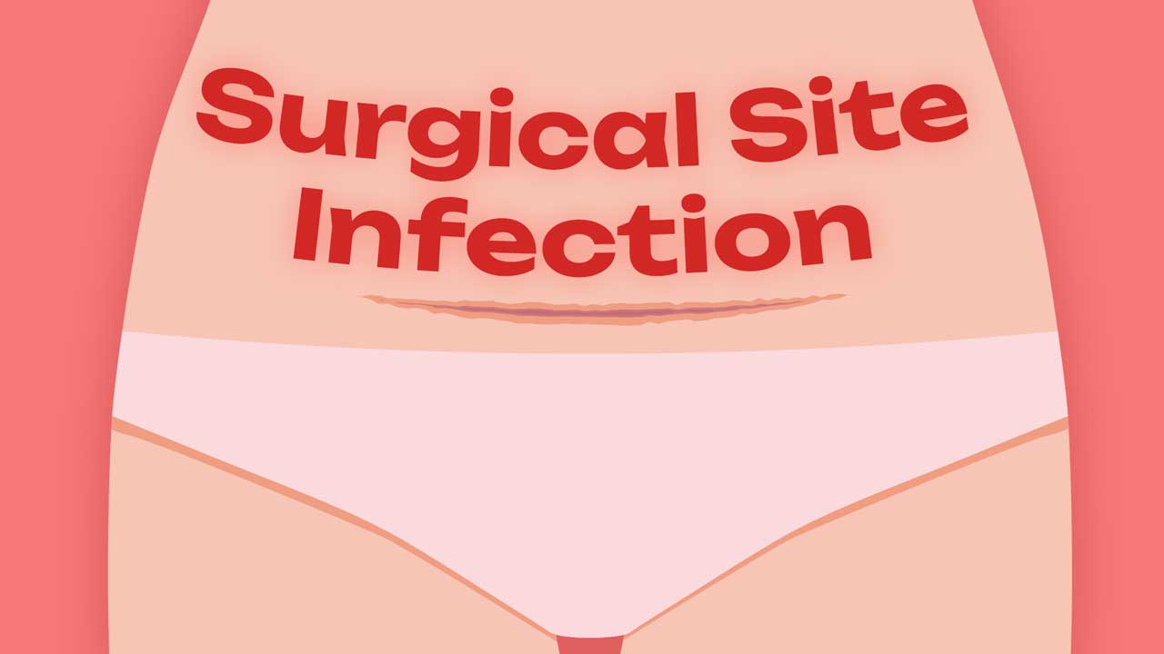 Image for Preventing Surgical Site Infection Post-caesarean Birth