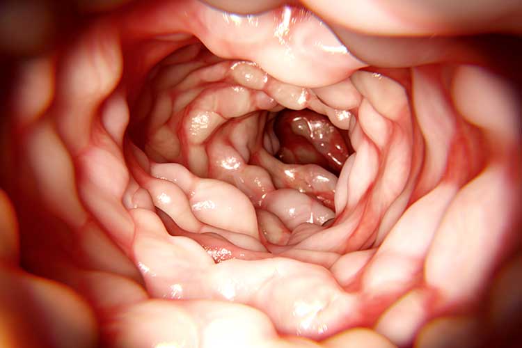 crohn's disease intestine