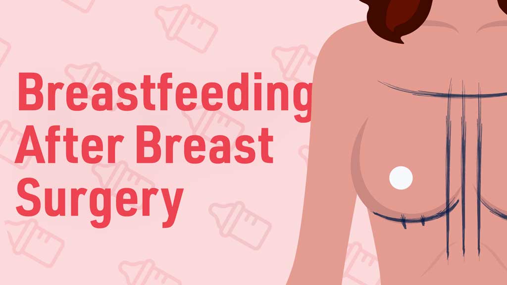 Breastfeeding After Breast Surgery