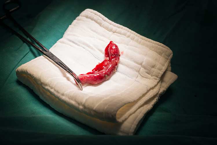 appendicitis appendix after appendectomy procedure
