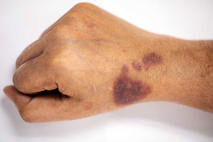 haemophilia symptoms bruising
