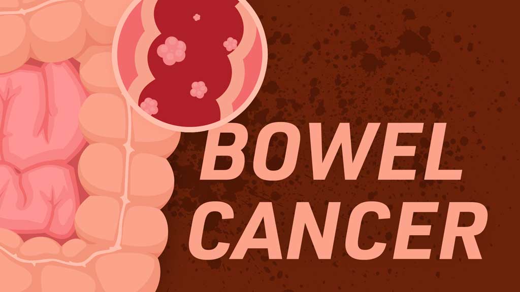 Image for Bowel (Colorectal) Cancer and Care