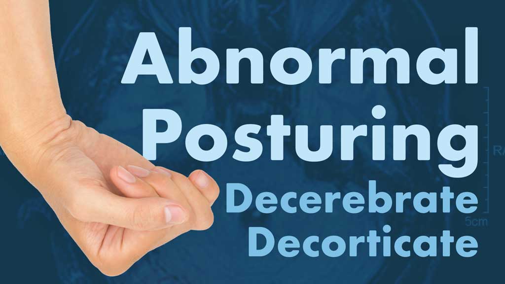 Image for Abnormal Posturing (Decerebrate and Decorticate)