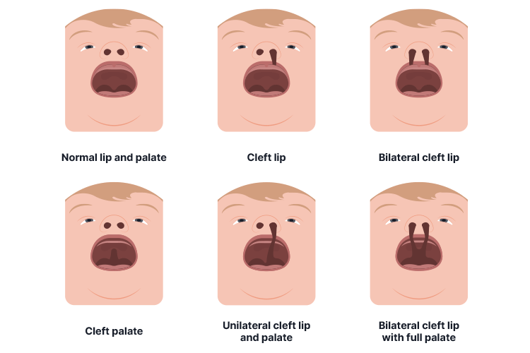 cleft lip and palate types
