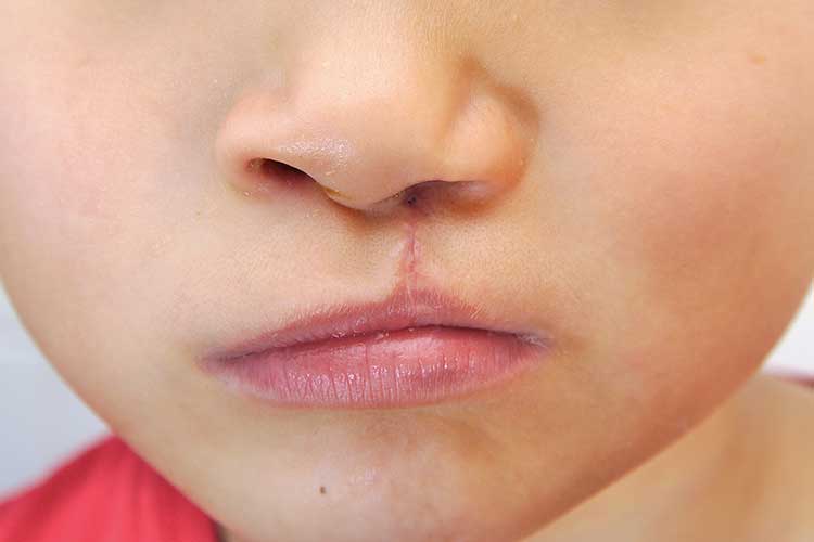 cleft lip scar after surgery