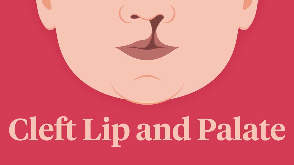 Image for Cleft Lip and Palate