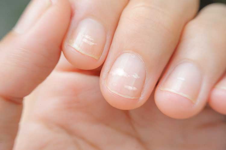 iron deficiency symptoms brittle nails