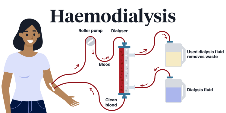 haemodialysis diagram