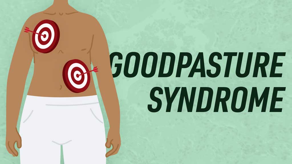 Image for Goodpasture Syndrome