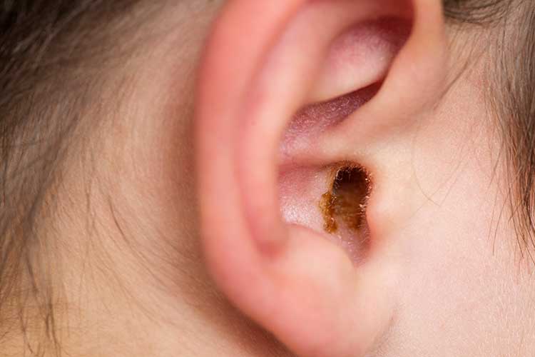 ear syringing cerumen impaction