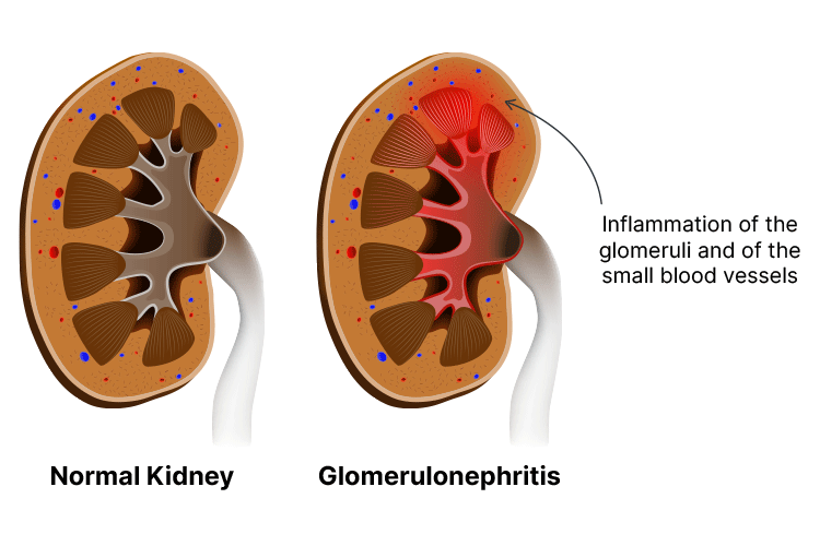 glomerulonephritis diagram