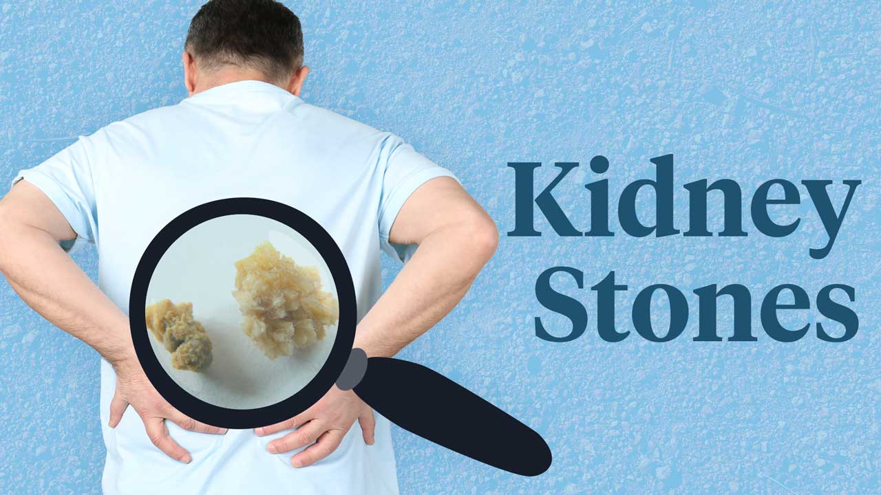 Image for Kidney Stones