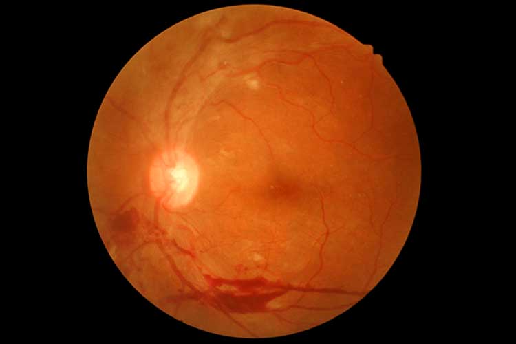 diabetic retinopathy eye