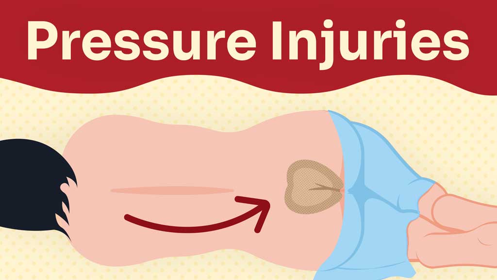 Image for Pressure Injuries